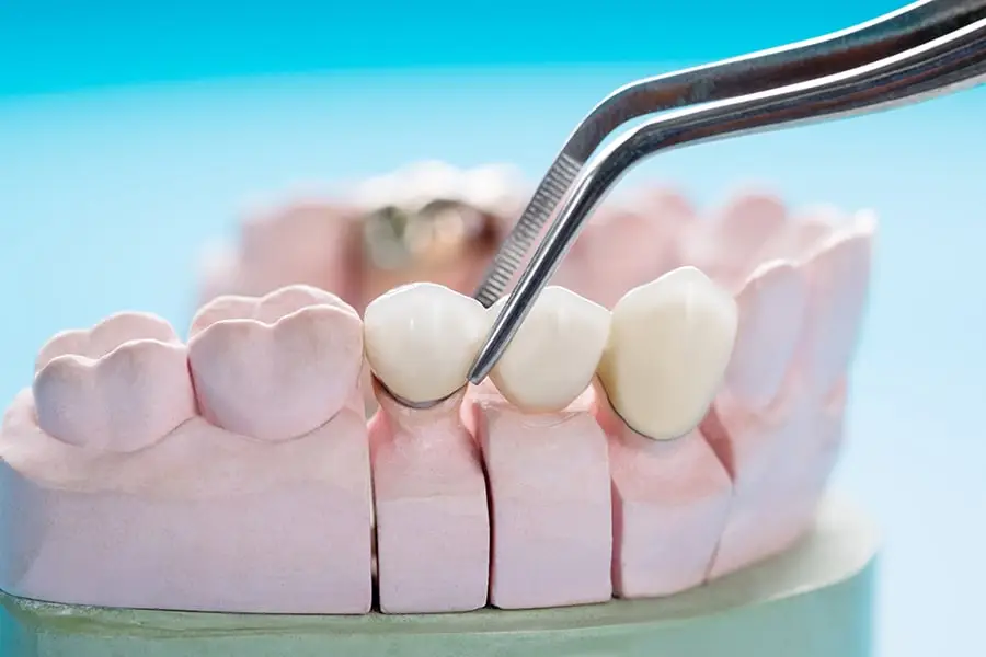 Punte dentară pe implant si dinte